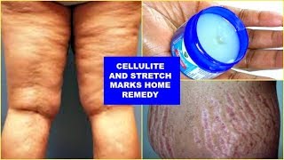 Cellulite removal treatments Dr Dray [upl. by Land]