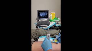 Pes Anserine bursitis injection under ultrasoundguidance [upl. by Charmine]