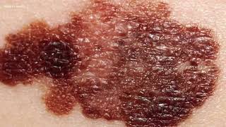 Concern that a blood pressure med can make you more atrisk for skin cancer [upl. by Nyleek]