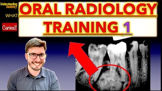 Radiographs Lesion Training Mixed Lesions Periapical X Ray and OPG interpretation dental students [upl. by Namrac]