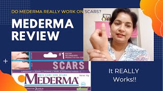 Mederma Cream Review for AcneBurn Scars and Stretch Marks [upl. by Notsuj]