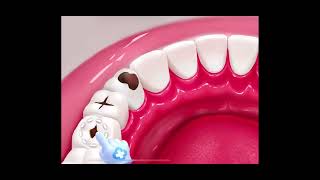 Ultimate Guide to Teeth Cavity Treatment  BeautyByte Animations [upl. by Yehudi495]