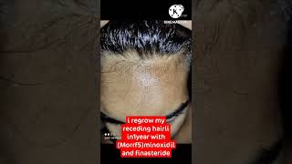 regrow receding hairline after 15 month use of minoxidil Finasteride shorts [upl. by Pamela]