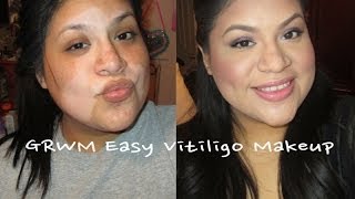 GRWM Easy Vitiligo Make Up [upl. by Yaeger]