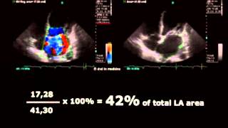 Volodymyr Pavliuk MD PhD Echocardiographic Assesment of Mitral Regurgitation [upl. by Tolecnal]