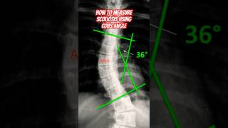 How to Measure Scoliosis 📐howto shorts doctor [upl. by Arykat]