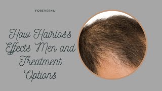 Understanding Androgenic Alopecia in Men Treatment Options [upl. by Lleinad]