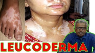 Leucoderma Treatment in Homeopathy by Dr PS Tiwari [upl. by Reve]