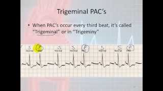 Basic Electrophysiology part 7  Atrial Rhythms part 1 Introduction and PACs [upl. by Primrosa976]