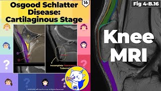 Fig 4B16 Osgood Schlatter Disease Cartilaginous Stage [upl. by Downing]