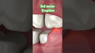 Pain in 3rd molar region dentist dentalhealth teeth dentalcare trending youtubeshorts viral [upl. by Amabel]