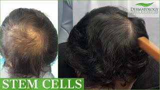 STEM CELL  PRP Therapy for Hair Loss with THREE MONTH UPDATE [upl. by Orfinger618]