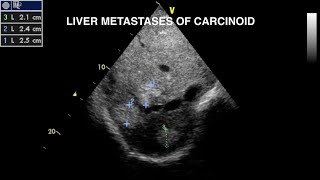 Carcinoid Disease Echocardiography [upl. by Loggins]