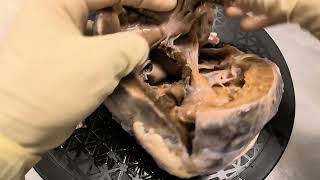 Specimen walkthrough 13 Double inlet double outlet right ventricle Cardiac anatomy pathology [upl. by Atiugal]