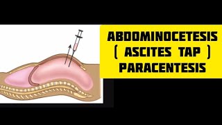 Ascites tap procedure  paracentesis  abdominocetesisn medics skills shorts [upl. by Kehoe]