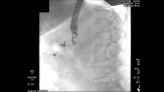 Fiducial Placement in Pancreas  Bronte Holt [upl. by Nester]