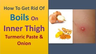 how to get rid of boils on inner thigh  Turmeric Paste amp Onion [upl. by Daren]