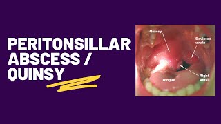 Retropharyngeal Abscess [upl. by Cherri]