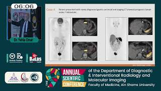 Valu of GalliumDotatate PETCT in Neuroendocrine Tumors [upl. by Maxantia976]