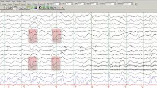 Learn to Read EEGs Part  4 [upl. by Notnirb]