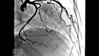 Coronary angiography views  coronary projections for left and right coronary arteries [upl. by Mandelbaum997]