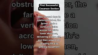 The First Successful Cesarean Section in History shorts [upl. by Auqenahs799]