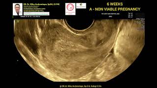 6 weeks A NoN Viable pregnancy [upl. by Breana]