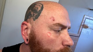 Day 1 Of Superficial Basal Cell Carcinoma Skin Cancer Treatment With Aldara Cream [upl. by Titus480]