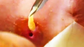 DISGUSTING BOT FLY REMOVAL  INSANE  NEW Video 2017 [upl. by Cornel891]