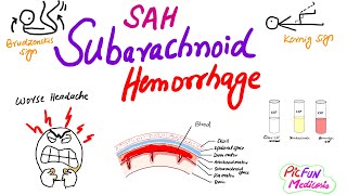 Subarachnoid Hemorrhageberry aneurysmSAHNeurosurgery [upl. by Carol-Jean]