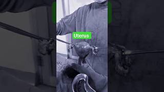 uterus fibroiduterus uterustransplant retroverteduterus shortsfeed shortvideo [upl. by Pierre339]