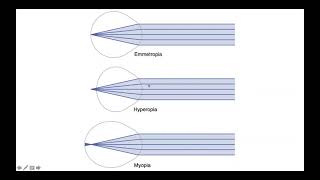 Emmetropia Hyperopia amp Myopia [upl. by Nayk96]