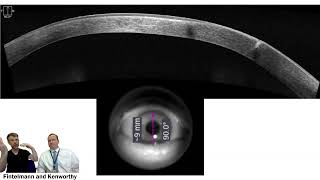 Revision of Gaping Astigmatic Keratotomy [upl. by Keelby]