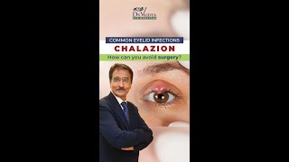 आँख की पलक में गाँठ Chalazion का कारण और उपचार  Dr Deepak Vaidya  Eye Surgeon [upl. by Eugene]