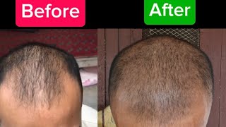 Mene jhut kaha ki naye baal agaye hai😢 Lets regrow hair naturally [upl. by Zerelda]