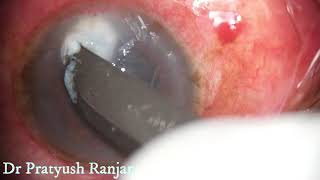 Therapeutic Corneal Ulcer Scraping [upl. by Acemat]