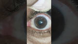 Successful trabeculectomy with patent PI of glaucoma patient youtubeshorts youtube glaucoma [upl. by Yramanna]