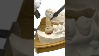 Mini Syton Molar Implant lsk121shorts teeth dentistry [upl. by Koh767]