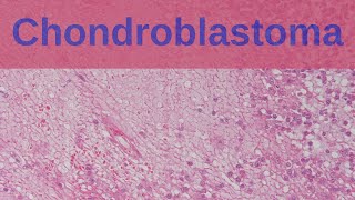 Chondroblastoma  Pathology mini tutorial [upl. by Nameloc335]