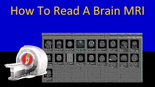 How To Read A Brain MRI  Neuroradiology Made Easy Maybe [upl. by Harte822]