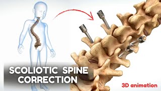 Scoliotic spine correction  Animated Video [upl. by Fulks]