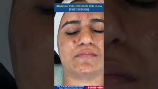 Chemical peel for acne and glow  Dr Shilpa Jaiswal  9838014988  drshilpajaiswal acne [upl. by Musihc]