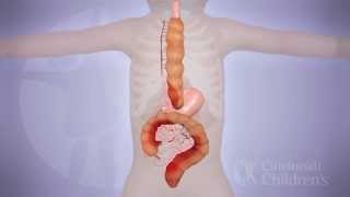 LongSegment Colonic Interposition for Esophageal Atresia 3D Animation [upl. by Garmaise]