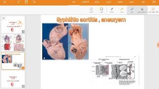 Syphilitic aortitis syphilitic aortic aneurysm [upl. by Ecidnarb]