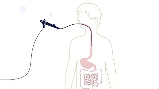 What is an Esophagogastroduodenoscopy EGD [upl. by Jeanna370]