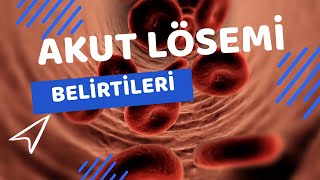 Akut LÃ¶semi Belirtileri Nelerdir  Akut LÃ¶seminin 5 Belirtisi [upl. by Initof729]