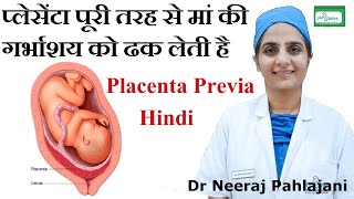 Placenta Previa होने के लक्षण इलाज और Low Lying Placenta से कैसे बचे [upl. by Arden]