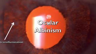 Ocular Albinism [upl. by Nhguavahs]