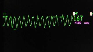 ventricular tachycardia  Torsade de Pointes on an ECG heart monitor [upl. by Nerraw]