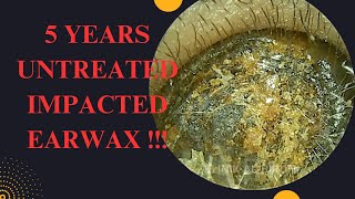 5 YEARS Untreated Impacted Earwax Very Satisfying Result [upl. by Zetnom]